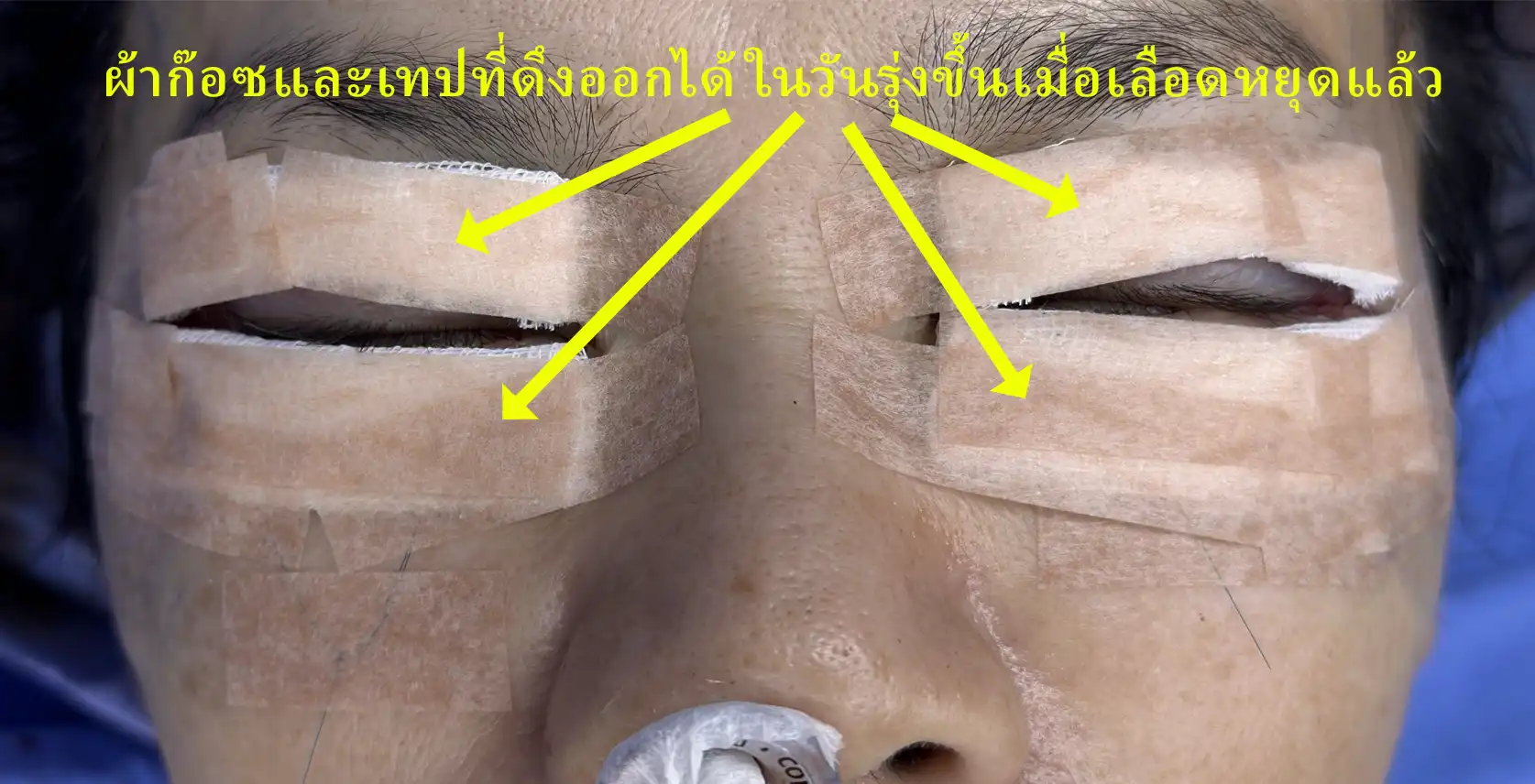 Do not pull out the long suture ends secured with tape. The tape and gauze dressing covering the wounds can be removed the following day, as the bleeding will have stopped.
