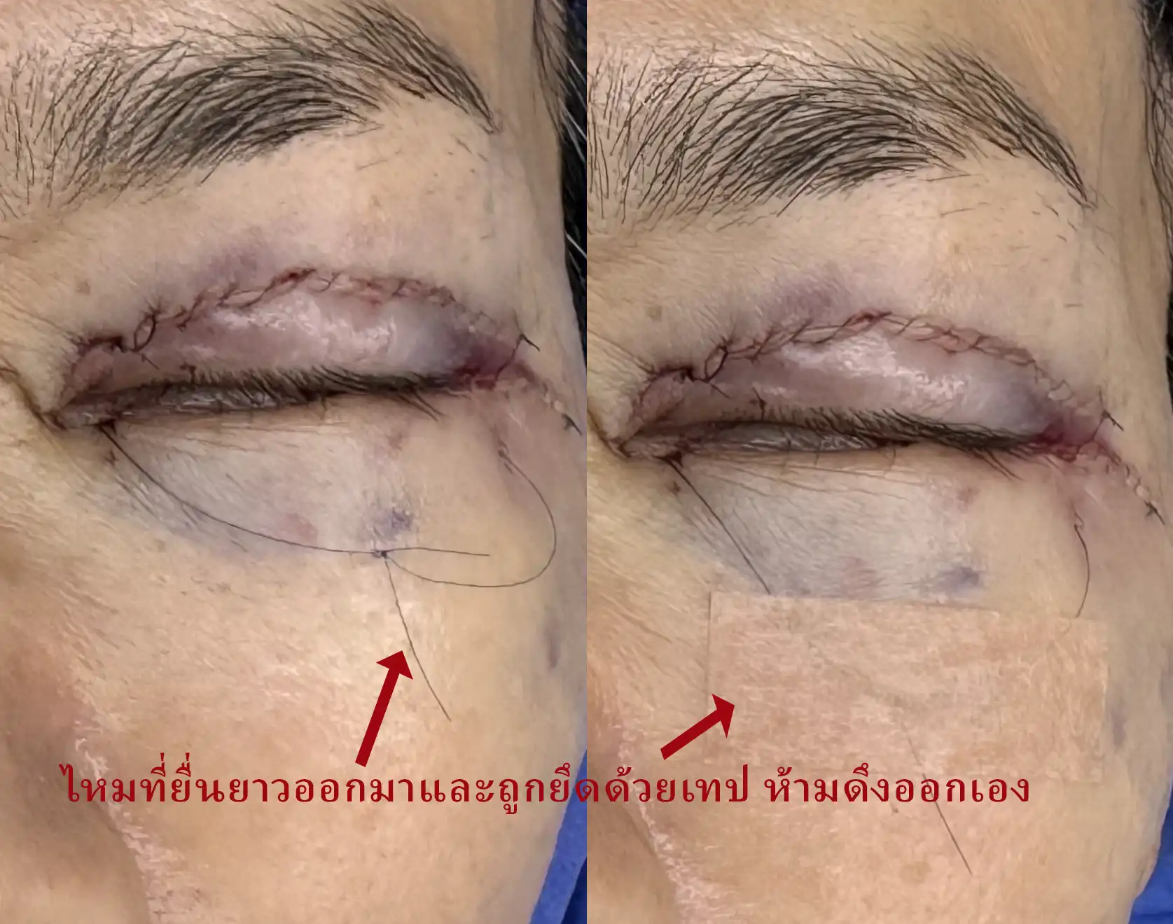 Do not pull out the long suture ends secured with tape. The tape and gauze dressing covering the wounds can be removed the following day, as the bleeding will have stopped.