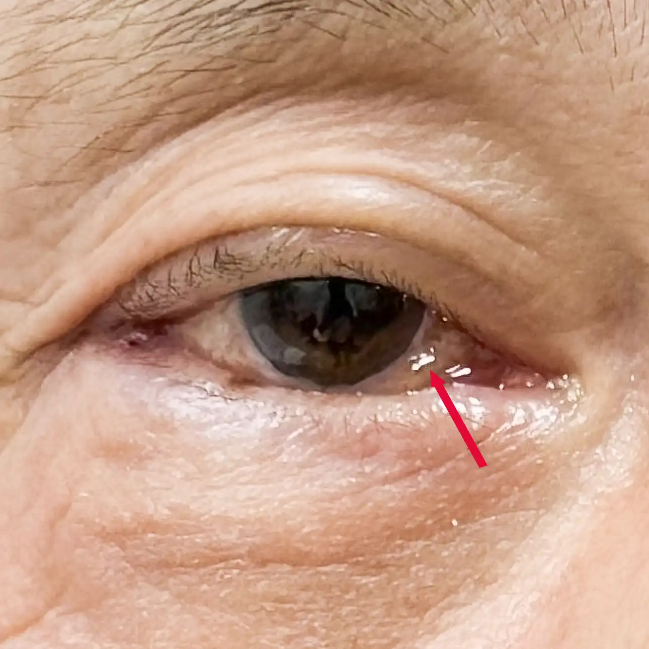 Following lower eyelid surgery with an internal incision, some patients may experience swelling of the conjunctiva (chemosis), ranging from mild to significant.