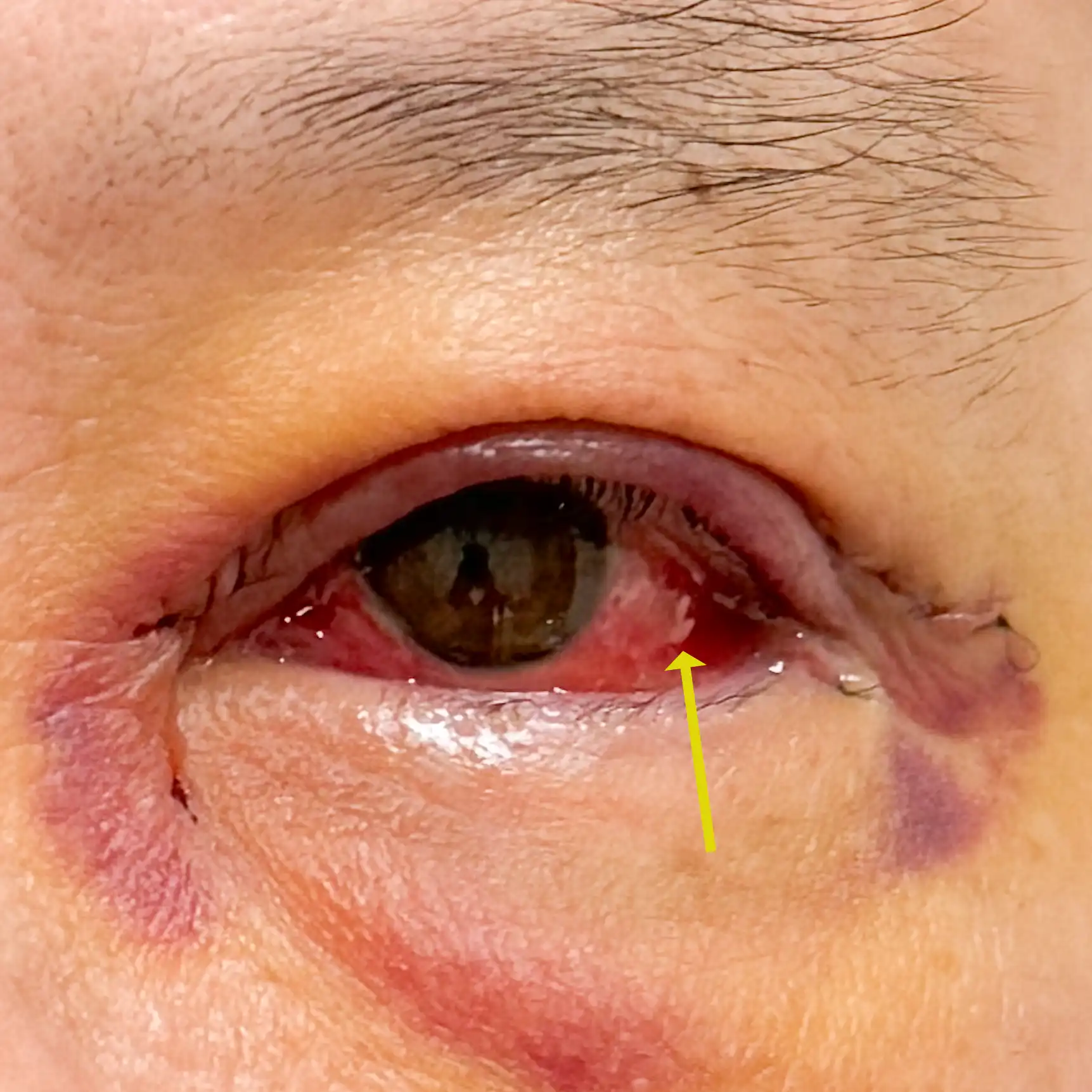 Following lower eyelid surgery with an internal incision, some patients may experience swelling of the conjunctiva (chemosis), ranging from mild to significant.